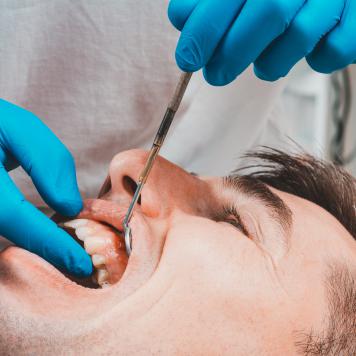 Fistola dentale
