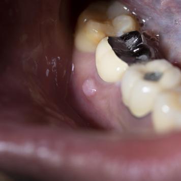 Granuloma dentale si riassorbe 