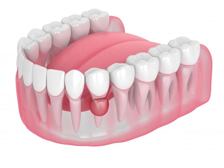 Granuloma dentale è pericoloso