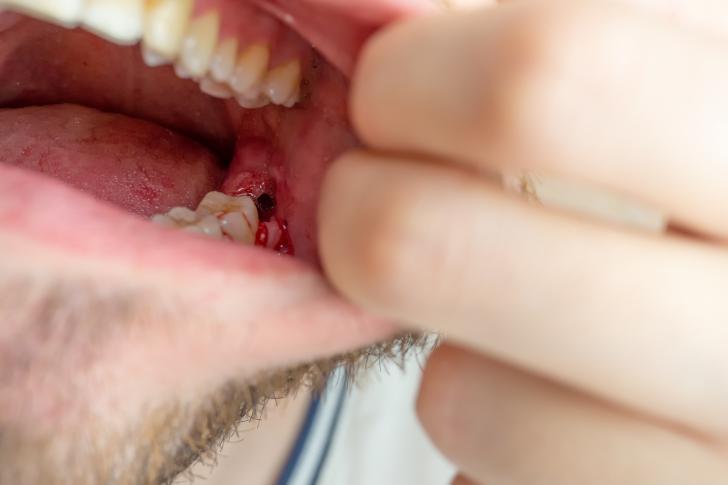 Granuloma dentale si riassorbe 