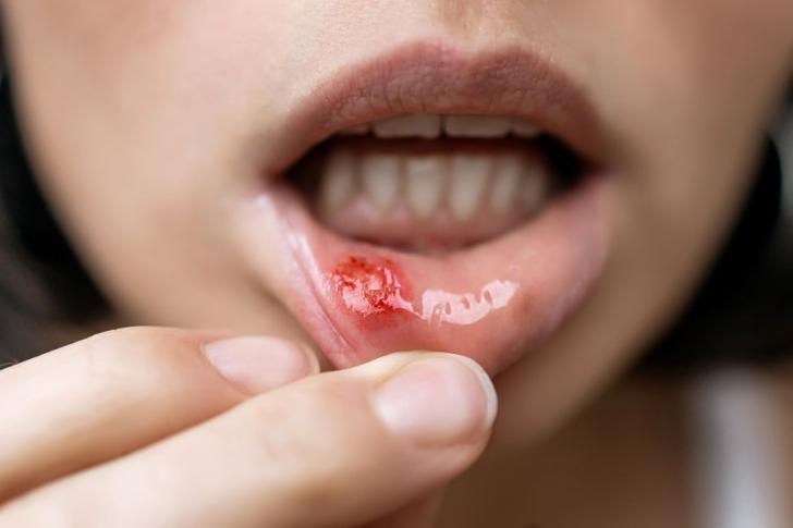 Infiammazione della mucosa orale
