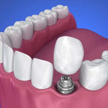 Denti fissi in un giorno prezzi