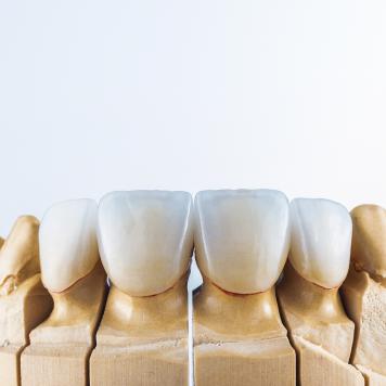 Impianto dentale 4 denti