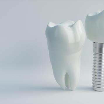 Impianto dentale quando manca l'osso