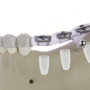 Implantologia dentale complicanze