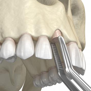 Innesto osseo dentale rigetto