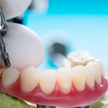 Overdenture su impianti