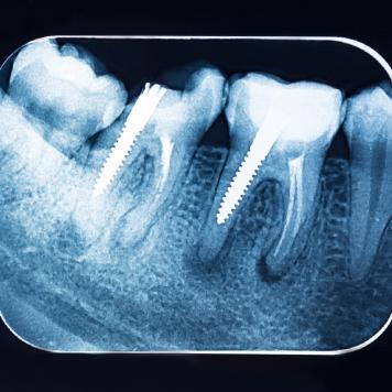 Quanto costa mettere un dente fisso con perno