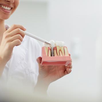 Tecniche implantologia dentale
