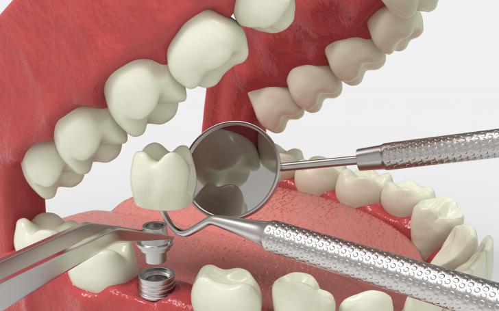 Implantologia dentale arcata inferiore