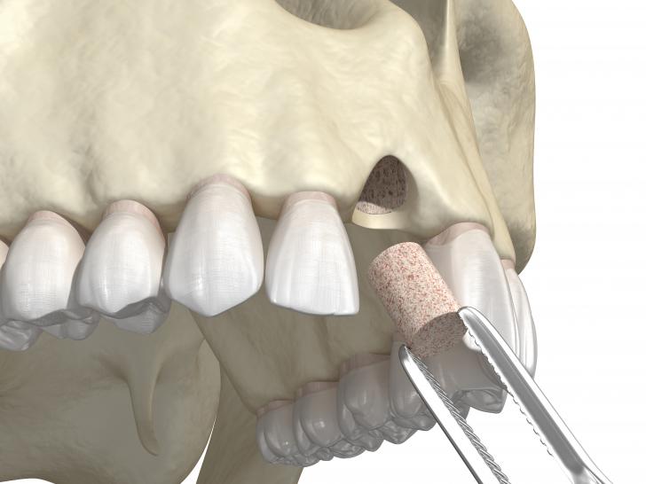 Innesto osseo dentale prezzi