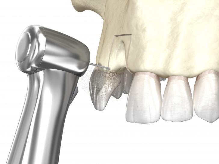 Innesto osseo dentale rigetto