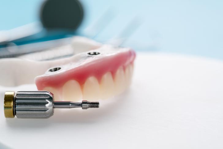 Overdenture su impianti